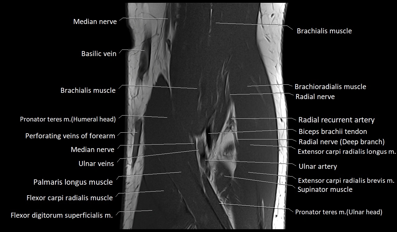 Elbow coronal anatomy image  cross sectional 3T MRI image 12.webp